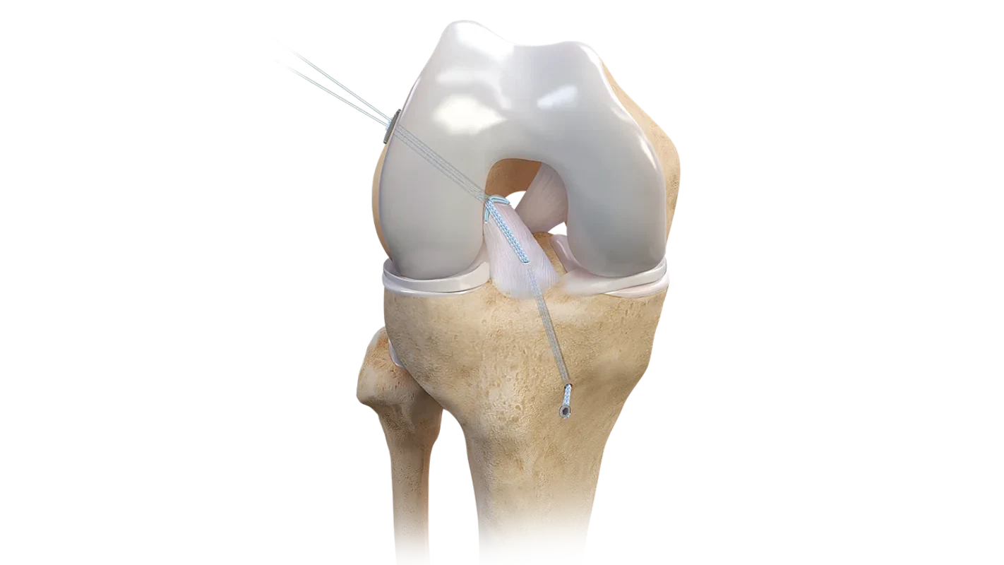 D_ACL_Repair_TightRope_Implant_with_FiberRing_Sutures_vkvj8g