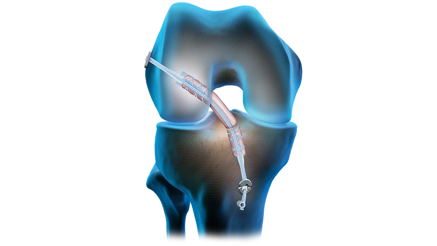 Quad_Tendon_Graft_ACL_Reconstruction_brektr